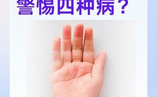 新生儿手脱皮到底该擦什么？日常护理与用药选择指南