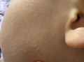 儿童脸颊两侧长小颗粒是湿疹还是过敏？需要治疗吗？