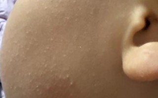 儿童脸颊两侧长小颗粒是湿疹还是过敏？需要治疗吗？