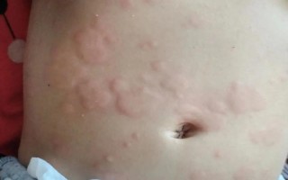 儿童身上长红疹是芥疮吗？症状和图片如何辨别？