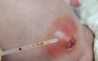 新生儿肚脐渗液图片正常吗？需要警惕哪些感染信号？