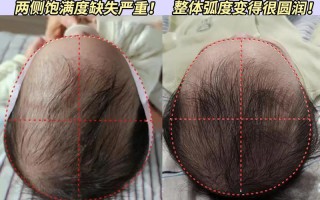 新生儿头长偏大怎么办？会影响发育吗？需要干预吗？