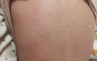 儿童皮炎症状图片大全