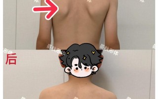 儿童肩胛骨突出是正常现象还是疾病信号？家长该如何科学干预？