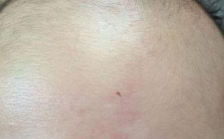 新生儿额头V字红斑图片是正常现象还是疾病信号？