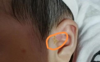 新生儿耳朵出现黄水结痂是正常现象还是感染信号？需要如何正确处理？