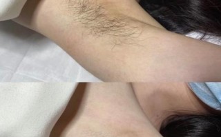 备孕期脱腋毛安全吗？
