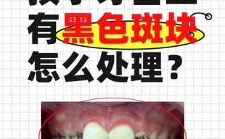 儿童牙齿长出难看黄斑，到底用什么方法才能彻底去除？