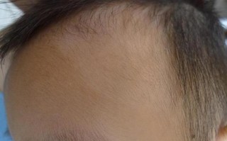 新生儿脑门上有一片白