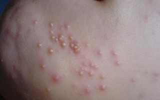 新生儿为何会感染脓包疹？病因与护理关键点解析