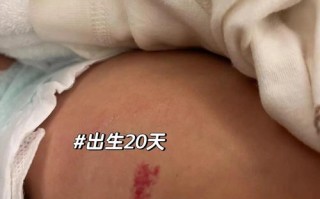新生儿为何会长血管瘤？背后原因与家长该知道的科普解答