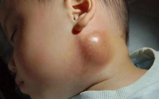 新生儿脖子长小脓包图片是正常现象吗？需要怎么处理？