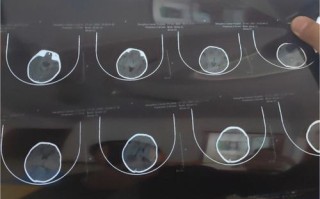 新生儿CT脑白质密度低是正常发育现象还是病理性异常？