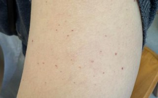 孕期胳膊出现小红点并伴随瘙痒，是哪些原因导致的？需要特别关注吗？