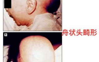 新生儿脑密度低会有哪些具体症状？家长该如何早期识别与应对？