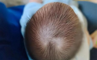 新生儿头顶头发竖起来是缺钙还是正常现象？需要干预吗？