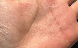 儿童手心痒是缺少微量元素还是皮肤过敏？别忽视这些潜在原因！