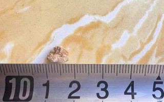 孕期肾积水合并输尿管结石怎么办？对胎儿有影响吗？