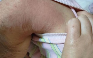 儿童过敏性皮炎多久能好？反复发作怎么办？家长该如何科学护理？