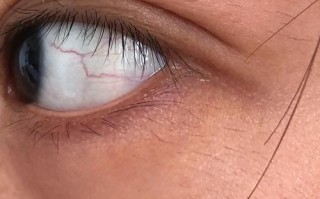 新生儿视网膜血管发育异常，究竟会对视力造成哪些潜在影响？