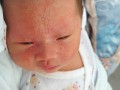 夏天新生儿脸上长痘痘是痱子还是湿疹？该如何正确护理与治疗？