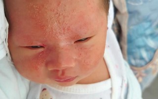 夏天新生儿脸上长痘痘是痱子还是湿疹？该如何正确护理与治疗？