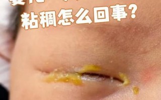 新生儿眼屎多又黄浓，是上火还是眼睛出问题了？