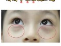 新生儿眼袋多久才能自然消退？是生理性还是需要警惕病理性原因？
