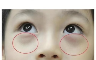 新生儿眼袋多久才能自然消退？是生理性还是需要警惕病理性原因？