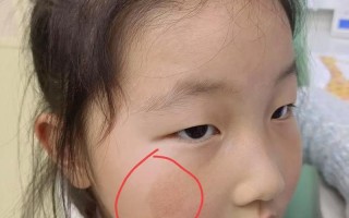 儿童祛斑最有效方法是什么？安全又无副作用的选择有哪些？