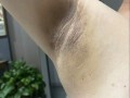 孕期腋下变黑多久能好？产后会自行消退吗？如何加速恢复？