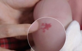 新生儿怎么判断是不是血管瘤
