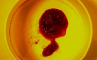 新生儿大便带红色黏液是感染还是肠道问题？需要立即就医吗？