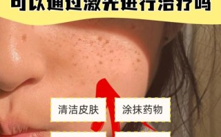 儿童脸上长斑是什么原因？该如何科学有效解决？