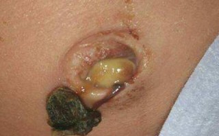 新生儿肚脐化脓了到底有多严重？会不会影响宝宝健康啊？