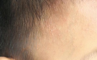 新生儿脸上长白色粉刺图片显示的是正常现象吗？需要如何护理和区分其他皮肤问题？