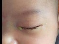 新生儿一流泪眼睛就红，是正常现象还是隐藏眼部问题？