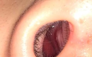 新生儿鼻子里的鼻痂需要清理吗？不清理会影响呼吸吗？