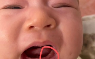 新生儿上牙龈马牙图片是什么样的？需要治疗吗？