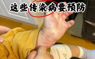 新生儿感染疫情后会有哪些症状？家长该如何科学护理与预防？