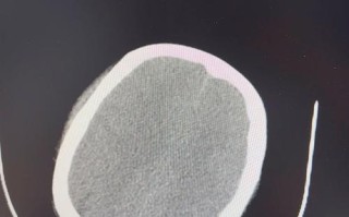 顺产新生儿蛛网膜出血是分娩意外还是可预防风险？