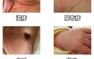 儿童湿疹频发，是过敏体质作祟还是日常护理疏漏所致？