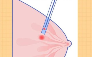 孕期乳腺穿刺到底能不能做？对胎儿有影响吗？