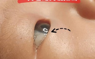 新生儿眼球发黄是黄疸吗？需要就医检查吗？