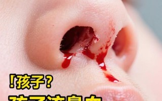 儿童右鼻孔经常流鼻血是鼻腔局部问题还是全身性疾病信号？