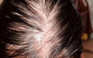 孕期斑秃的幕后推手有哪些？激素波动还是营养缺口在作祟？
