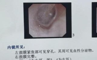 儿童耳朵出血是什么原因导致的？需要立即就医吗？