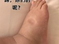 孕期水肿是否会引起手麻？背后的神经压迫机制是什么？