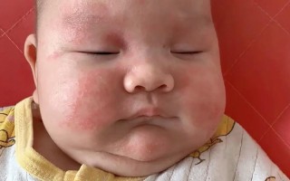 新生儿脸上小红点是啥原因？