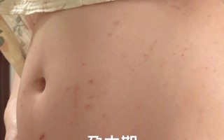 孕期胆汁淤积症图片长啥样？皮肤瘙痒、黄疸症状如何通过图片识别？